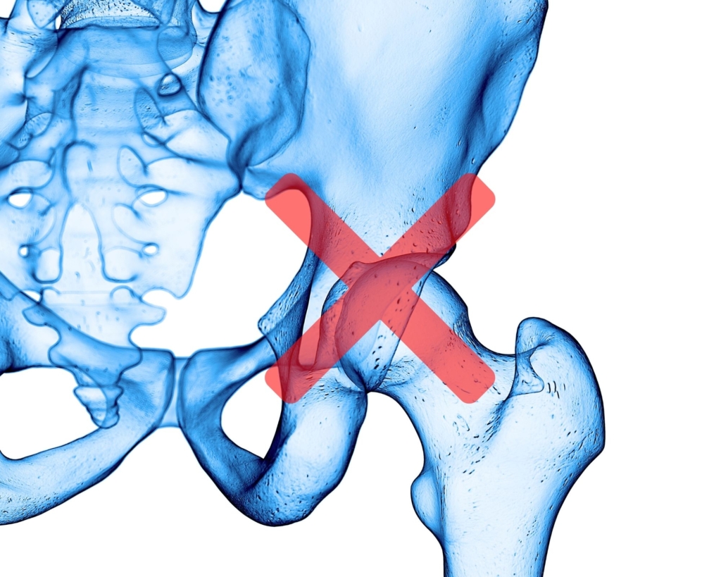 寛骨臼形成不全、臼蓋形成不全、変形性股関節症による股関節痛