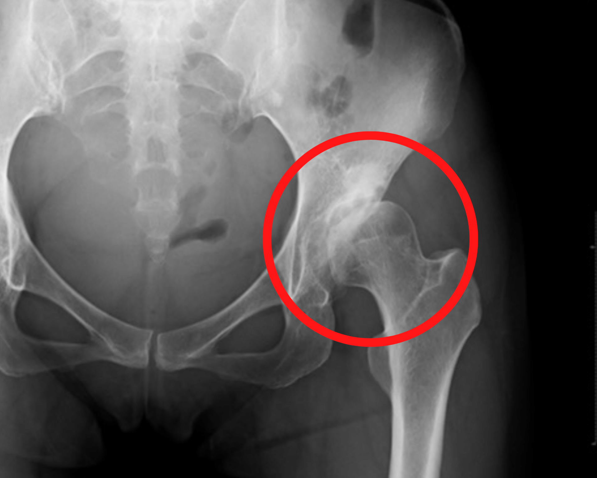 股関節インピンジメントにはどのような種類がありますか?